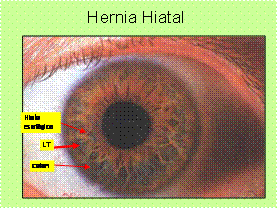 img-herniaHiatal